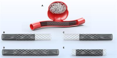 Retreatment with a pipeline embolization device for recanalized aneurysms following stent-assisted coiling embolization